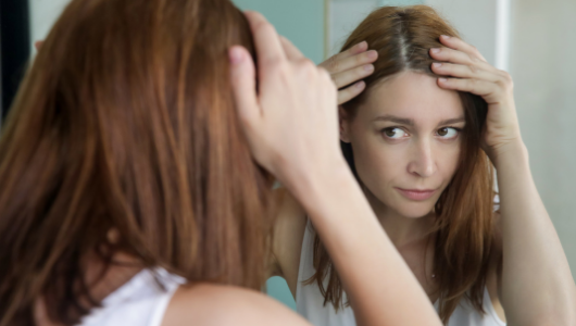 Tips for scalp care: Say goodbye to seborrheic dermatitis(圖)